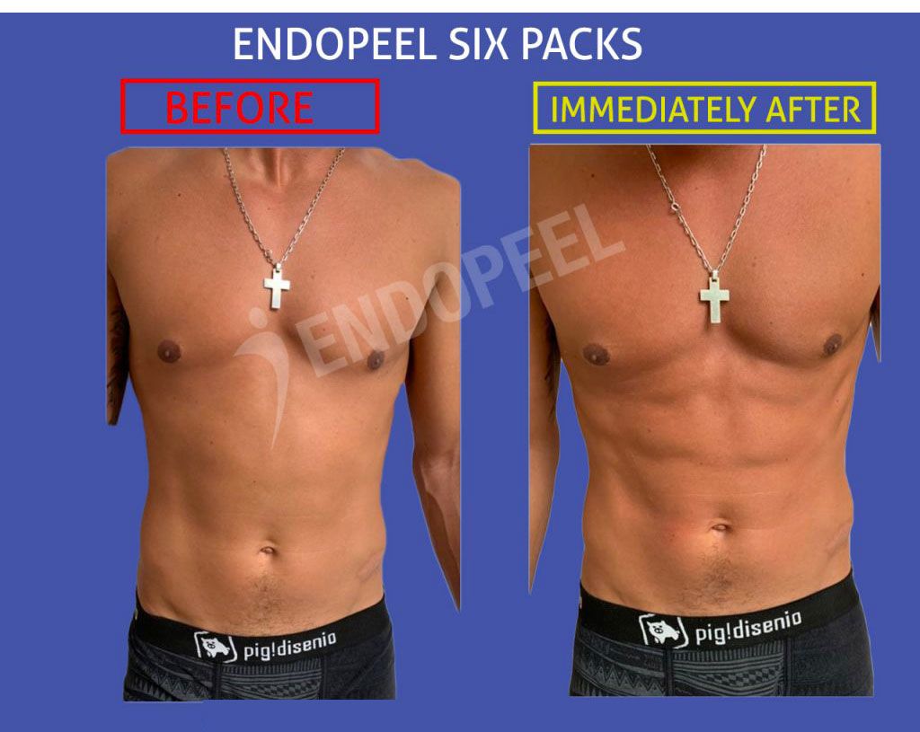 endopeel male 6 packs