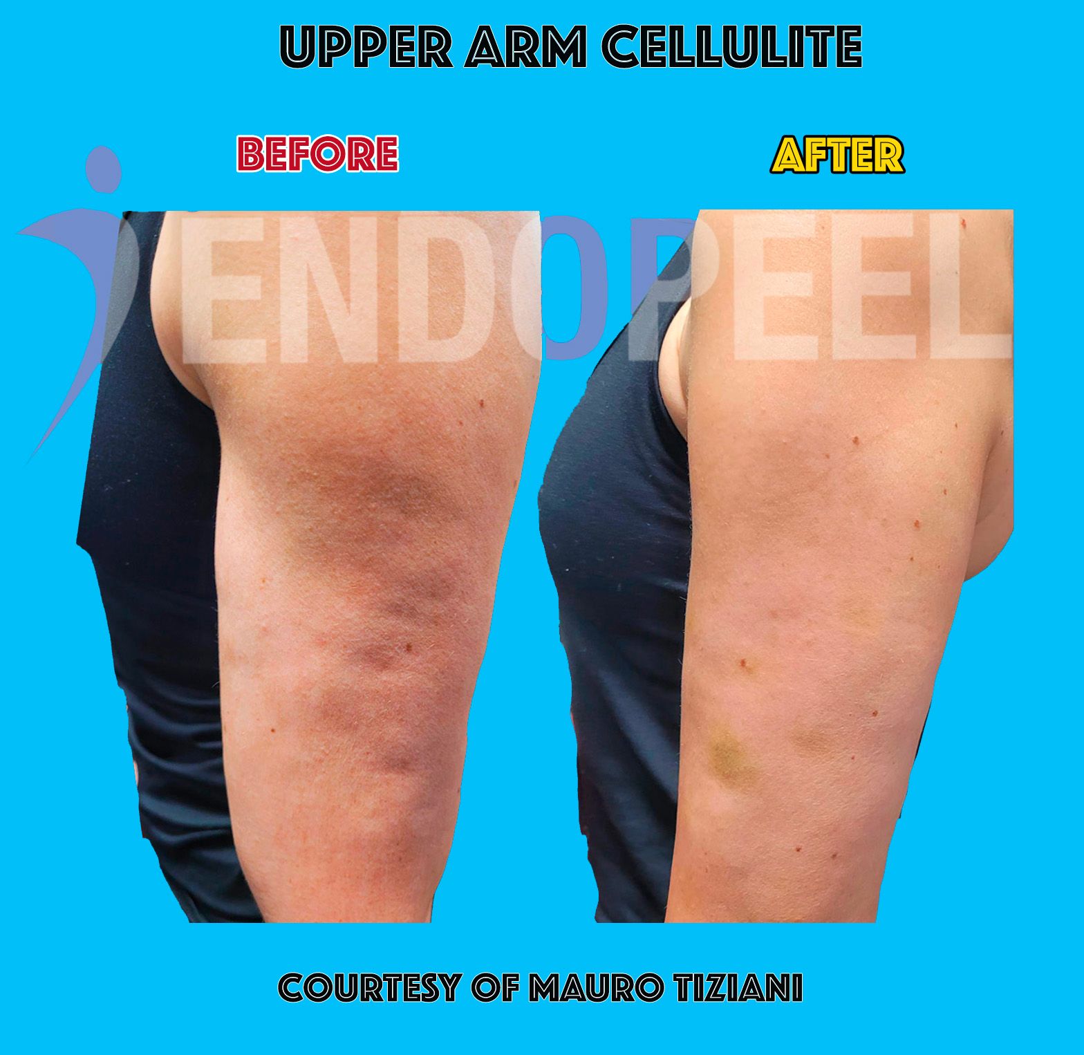 upper-arm-cellulite
