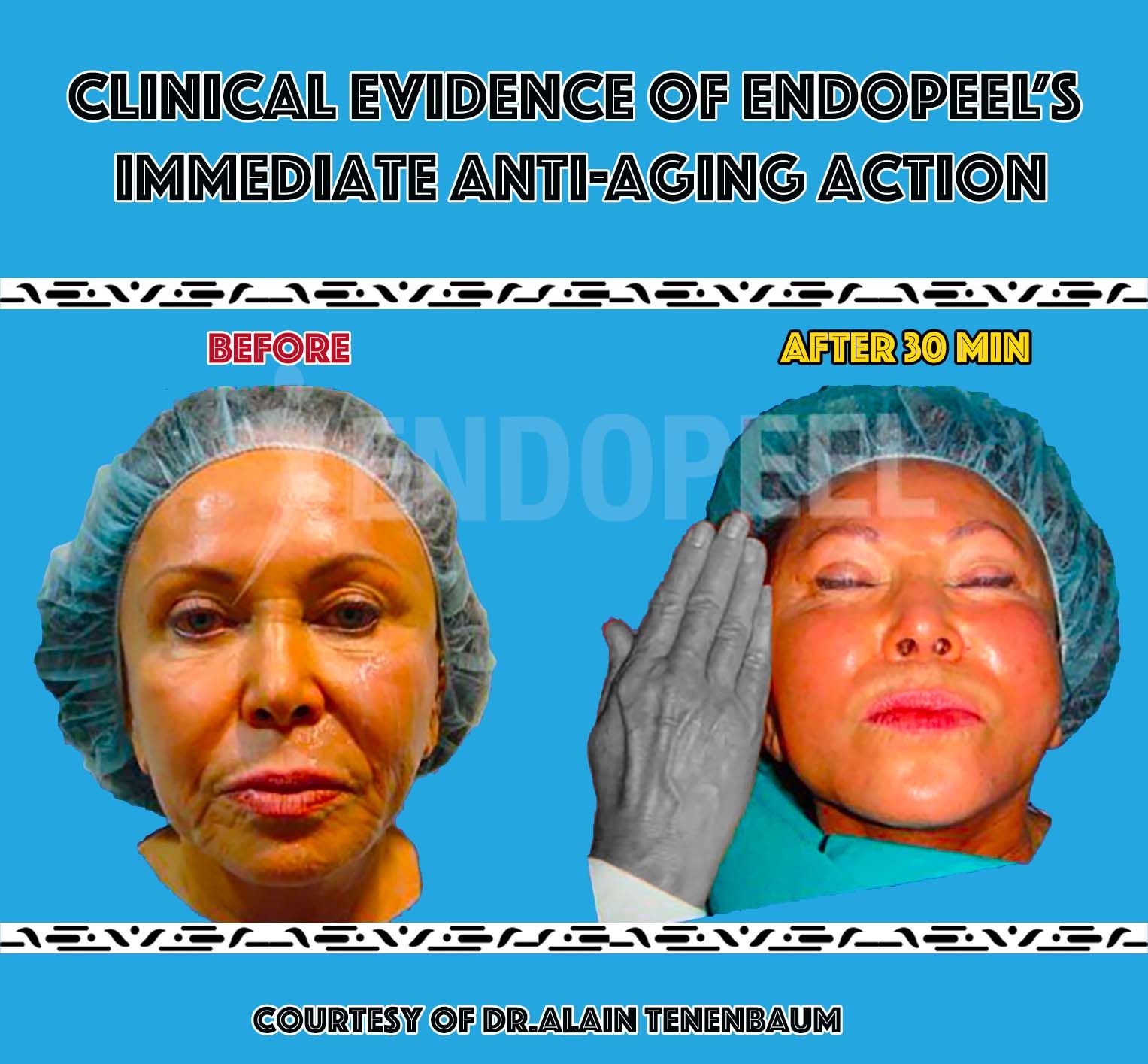 endopeel for aging face