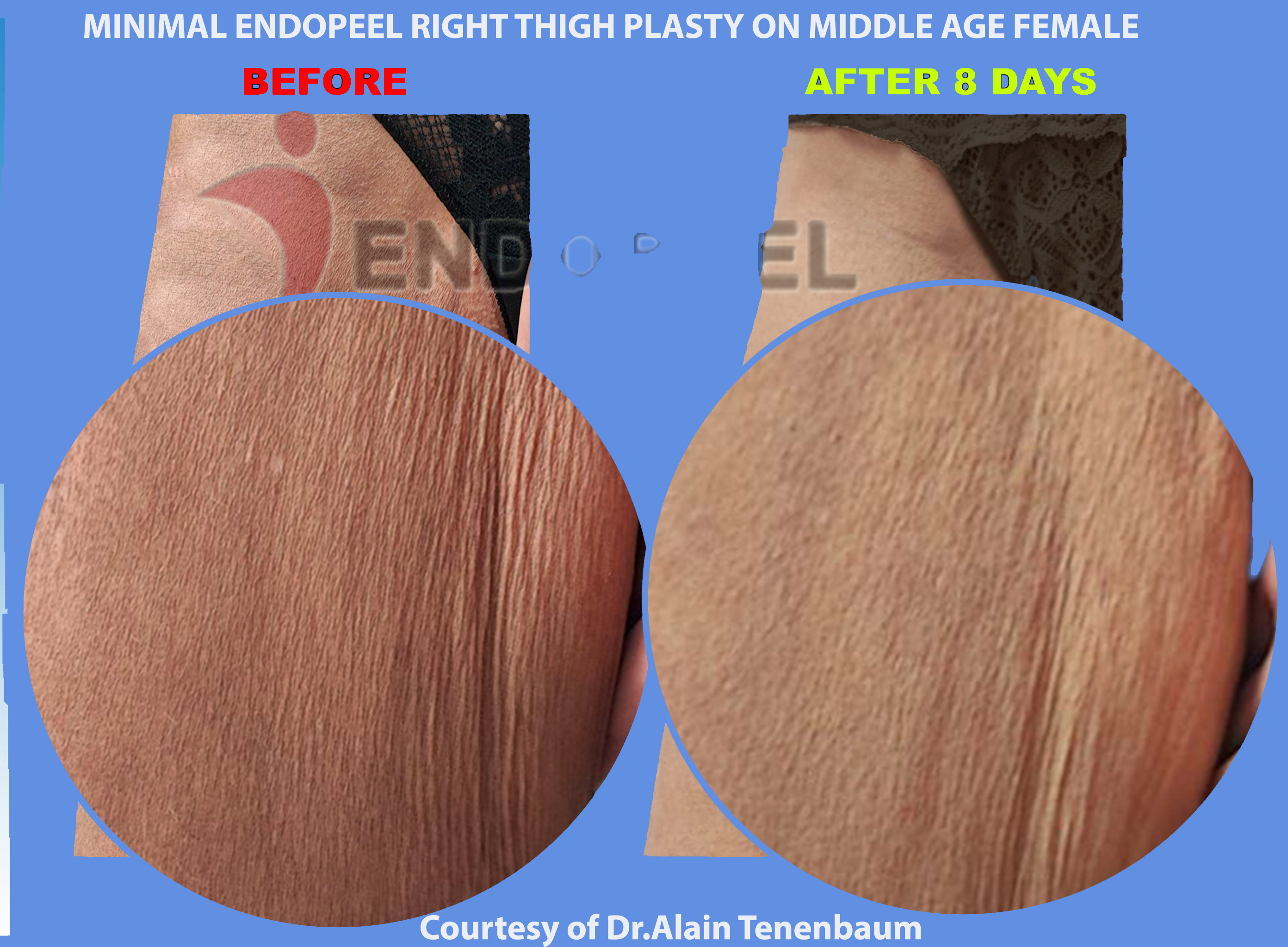 endopeel-thigh-plasty-zoom