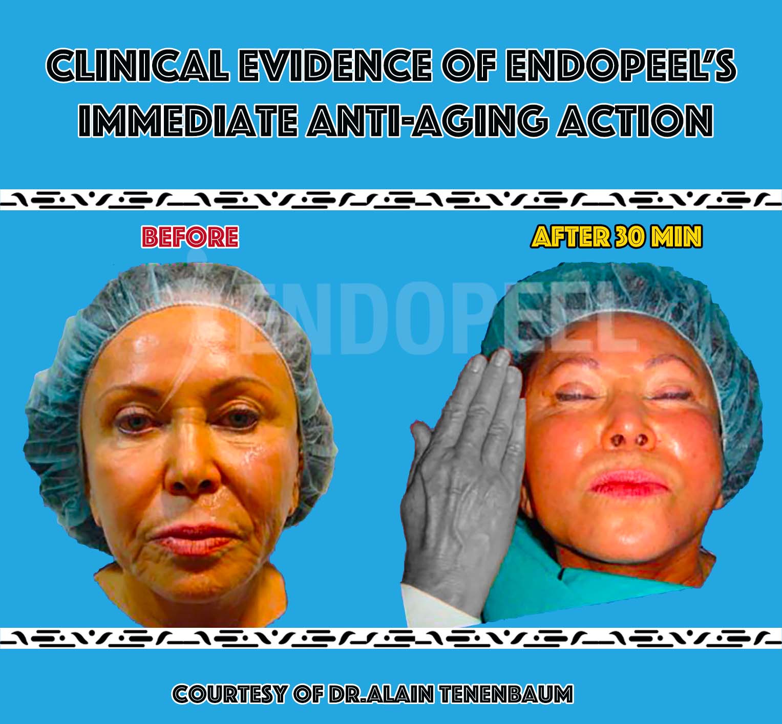 Anti-Aging-Indikation-Endopeel