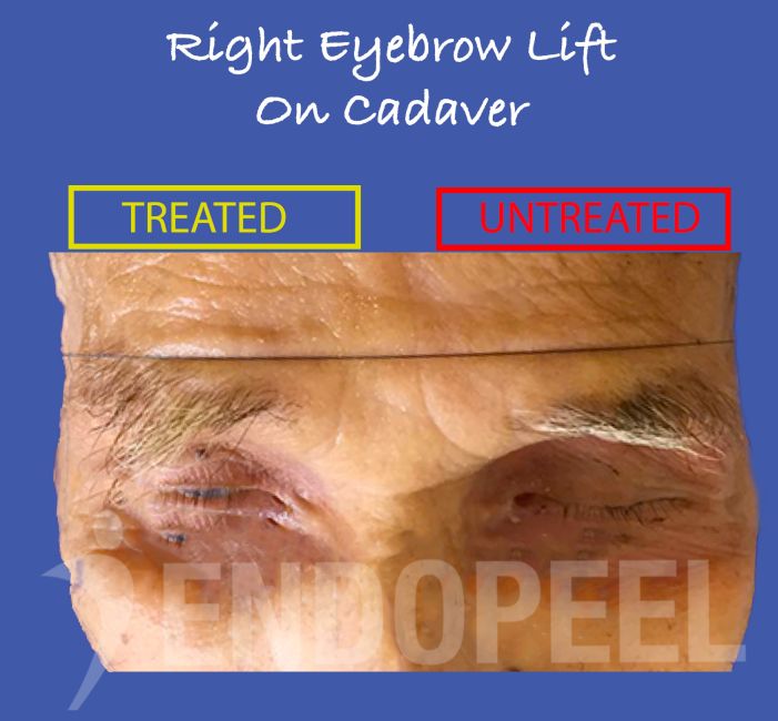 right-eyebrow-lift-cadaver