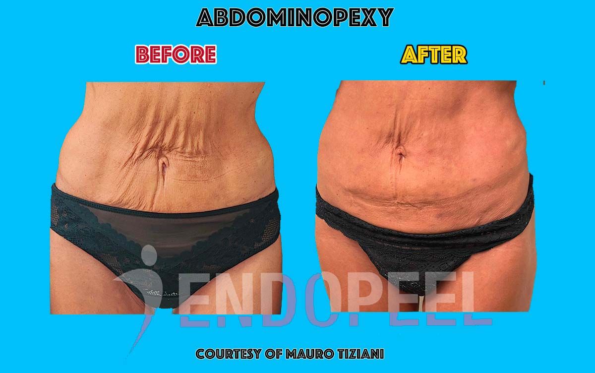 post lipoplasty