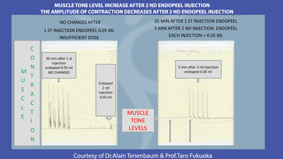 2nd-endopeel-injection