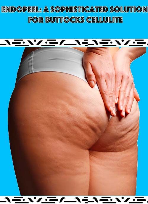 buttocks-cellulite
