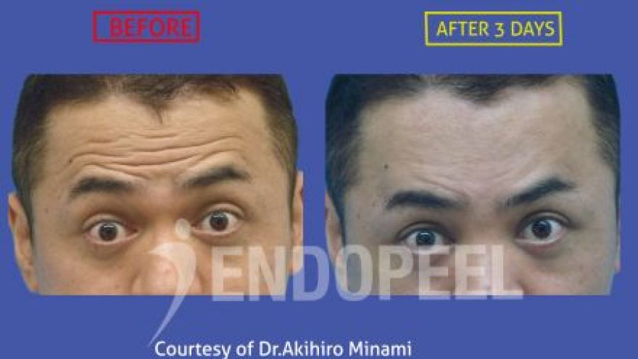 upper third face endopeel