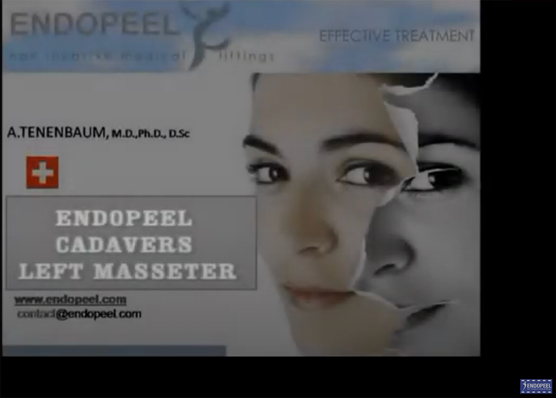 endopeel cadavers masseter