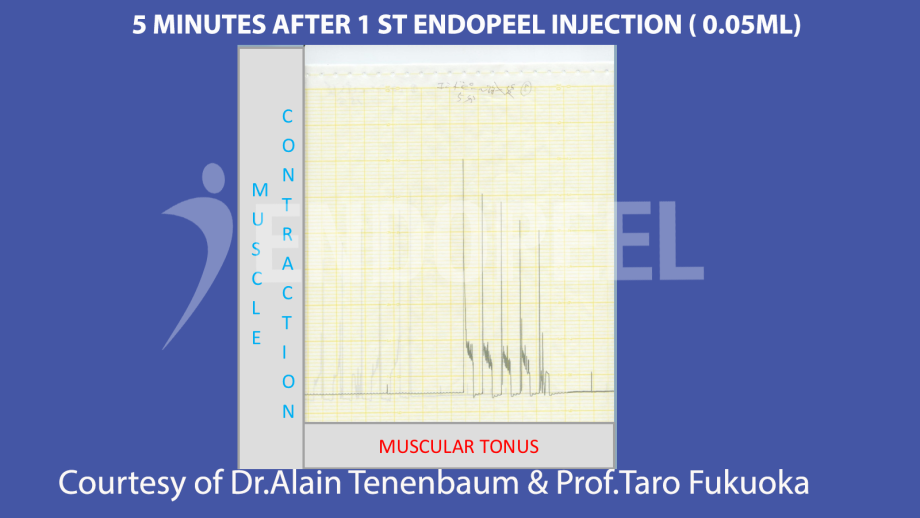 5 minutes after 1 st endopeel injection of 0.05 ml